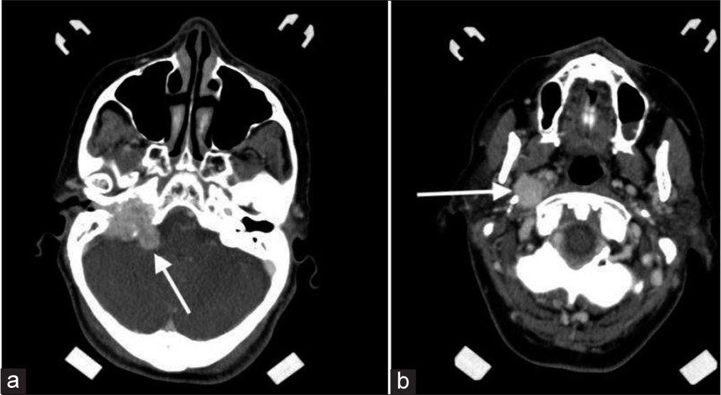 An 80-year-old female with the right glomus jugulare. (a) Axial contrast-enhanced computed tomography image at the level of cerebellopontine angle demonstrating lesion at the right cerebellopontine angle (arrow). (b) axial contrast-enhanced computed tomography image at the level of upper internal jugular vein demonstrates a contrast-enhancing lesion arising at the right jugular foramen and extending into the right internal jugular vein (arrow). This was surgically confirmed to be a glomus jugulare tumor.