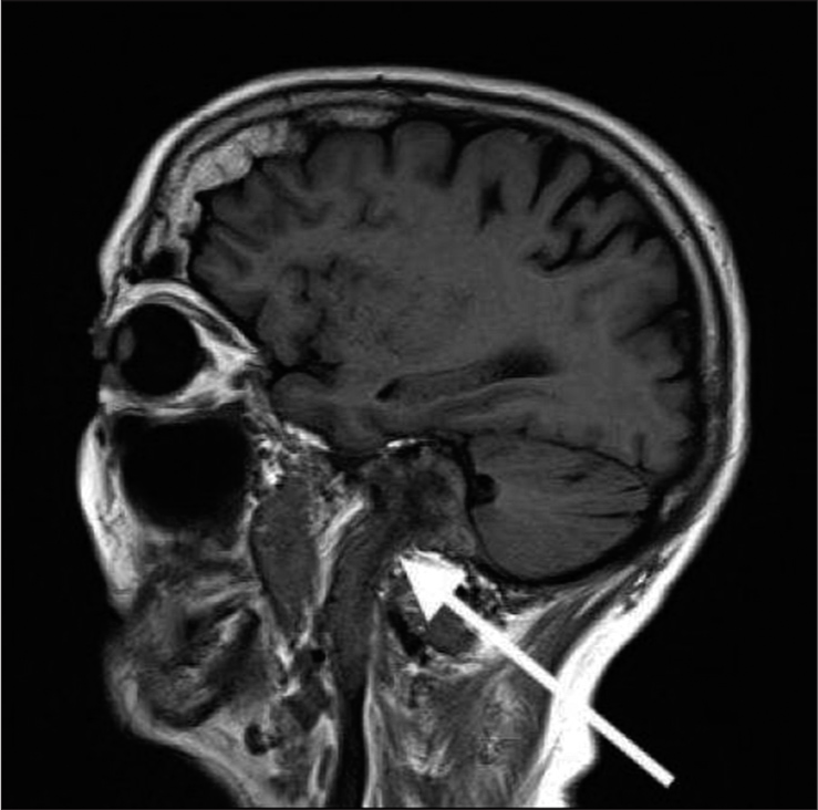 An 80-year-old female with glomus jugulare. T1 sagittal FLAIR magnetic resonance imaging sequence demonstrates a large mass (arrow) extending from the level of cerebellopontine angle through jugular foramen into the internal jugular vein.