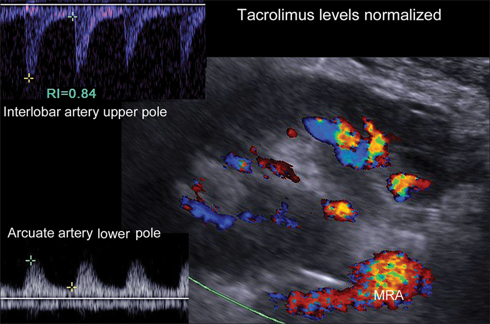 Color and spectral Doppler one day later in the same patient shows definite flow to the upper pole detectable on color Doppler. At this point, his tacrolimus level was in the normal therapeutic range. The patient had developed a hematoma (attributed to heparinization), which altered the orientation of the kidney necessitating a different angle of insonation. The image has been rotated to allow direct comparison with Figure 1. Spectral Doppler showed stable flow to the lower pole and definite arterial flow to the upper pole. Over the next several days, the creatinine-normalized and the hematoma resolved. He was discharged from the hospital with normal renal function.
