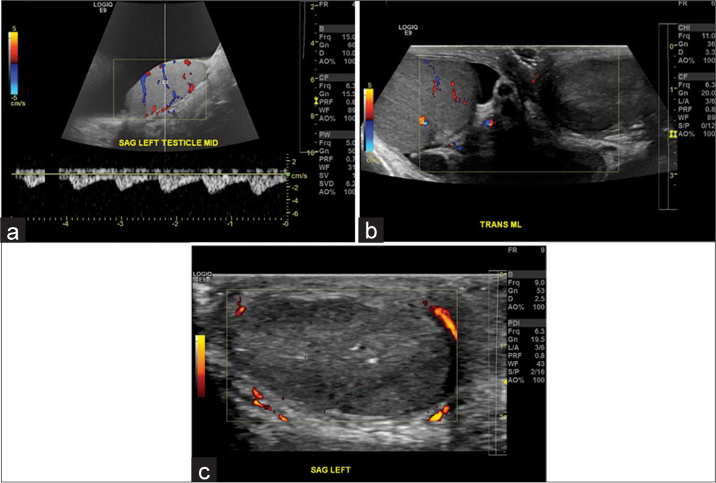 A 57-year-old male with a large hydrocele. (a) Sagittal view demonstrates a large hydrocele with normal testicular blood flow. (b) Patient subsequently underwent hydrocelectomy. Patient presented 6 months later with no flow in the left testis on color flow Doppler, consistent with testicular infarction. (c) Similar findings are observed on power Doppler. This rare complication of testicular infarction after hydrocelectomy has not been reported before in literature.