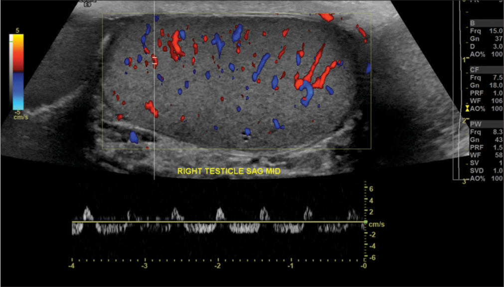 A 44-year-old male with right scrotal pain, found to have varicocele. Ultrasound examination demonstrated reversal of diastolic flow on the right side. Upon repeat imaging, normal arterial waveforms were demonstrated throughout the testis, without reproduction of the reversal of diastolic flow (not shown). The patient was asymptomatic throughout. This reversal of diastolic flow may be observed in a patient without partial testicular torsion. However, persistence of this pattern should always raise suspicious for testicular torsion and this condition should be excluded.