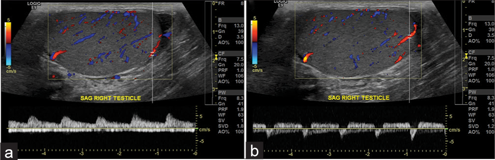 A 43-year-old male with right scrotal pain. (a) Normal waveform in the right testis. (b) Abnormal waveform in the lower pole of the same right testis, suggestive of “to-and-fro” pattern, which is commonly seen in the neck of a pseudoaneurysm. The sac of the pseudoaneurysm is not visualized in this study, likely secondary to the small size of the testicular arterial branch. This abnormal waveform most likely represents a congenital pseudoaneurysm of the testicular artery, as there was no history of trauma. However, most pseudoaneurysms of the testicular artery are traumatic or acquired.