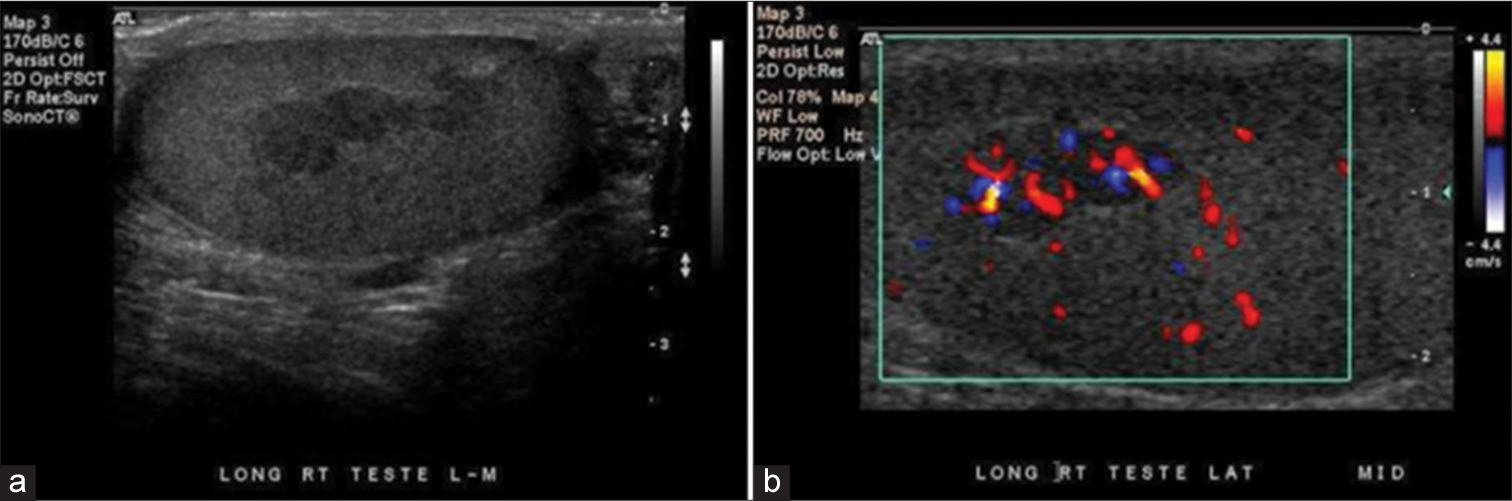 17-year-old patient with congenital adrenal hyperplasia. (a) Grayscale ultrasound demonstrates a lobulated, hypoechoic lesion along the length of the mediastinum testis, (b) color flow Doppler demonstrates significant vascularity within the lesion.