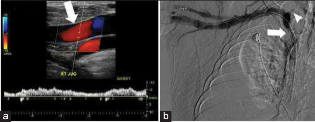 58-year-old male with right upper extremity arteriovenous fistula and central stenosis. (a) Real-time color and spectral Doppler demonstrate reversal of flow in the right internal jugular vein (IJV) (white arrow). (b) Venogram demonstrates central stenosis (white arrow) with reflux into a narrowed right IJV (white arrow head).