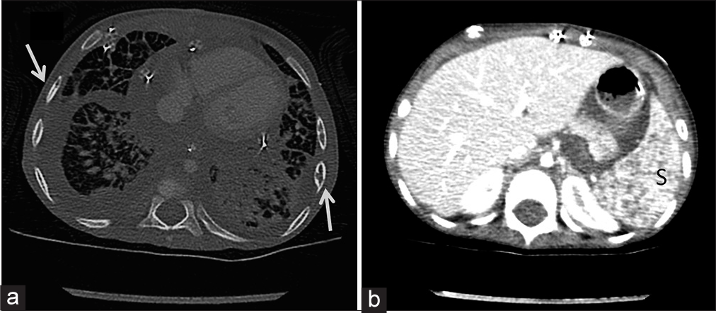 A 20-month-old boy with diffuse lymphangiomatosis who presented with respiratory failure. (a) Chest computed tomography (CT) with contrast demonstrates diffuse smooth interstitial thickening, multiple patchy air space consolidations mainly in the left; bony lytic lesions involving the ribs bilaterally (arrows); evidence of pericardial effusion and bilateral pleural effusion. (b) Abdomen CT with contrast revealed heterogeneous enhancement of the spleen(s) with multiple tiny cysts.