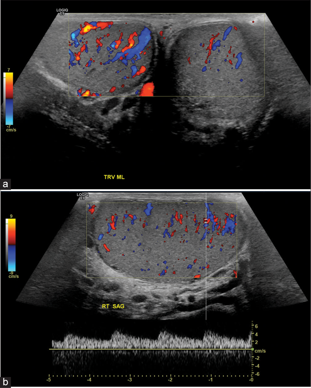 A 58-year-old male presenting with right scrotal pain and right inguinal hernia, status-post reduction. (a) Color-flow Doppler examination demonstrates reactive hyperemia of right testis secondary to prior ischemia. (b) Corresponding spectral Doppler confirms the presence of intratesticular blood flow.