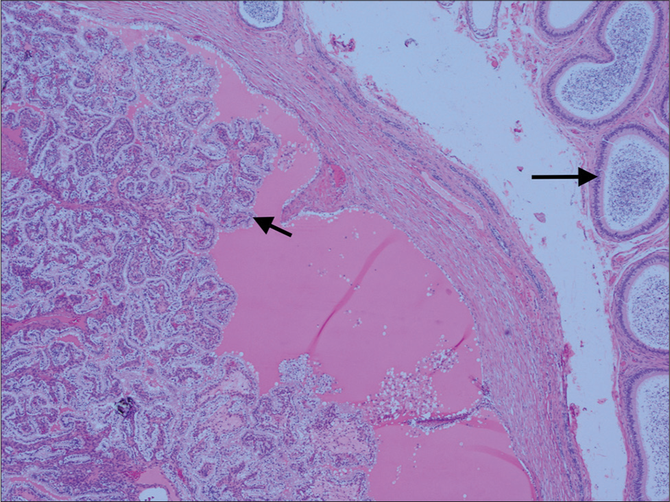 A 34-year-old male with Von Hippel–Lindau disease presented with the right testicular tenderness and abnormality. Histopathology (Hematoxylin and Eosin stain, ×5) demonstrates papillary fronds covered with epithelial cells filled with clear cytoplasm projecting into cystic spaces (short arrow). Arrow shows normal epididymis.