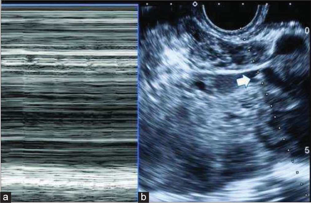 A 29-year-old female with scar pregnancy who presented with complaint of lower abdominal pain. (a) M-mode demonstrates cardiac activity. (b) Demonstrates fetal pole with M-mode cursor line (arrow).