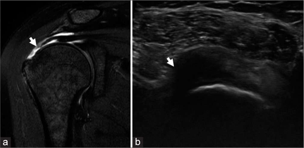 A 37-year-old female with difficulty in lifting her right arm, diagnosed to have supraspinatus full-thickness tear. Image (a) T2 (fat suppressed) coronal section showing full thickness tear involving the supraspinatus tendon (arrow) at its insertion site with retraction of the tendon. Image (b) Grayscale ultrasound long axis view showing loss of attachment of the supraspinatus tendon to its insertion site with a hypoechoic area extending into the tendon (arrow).