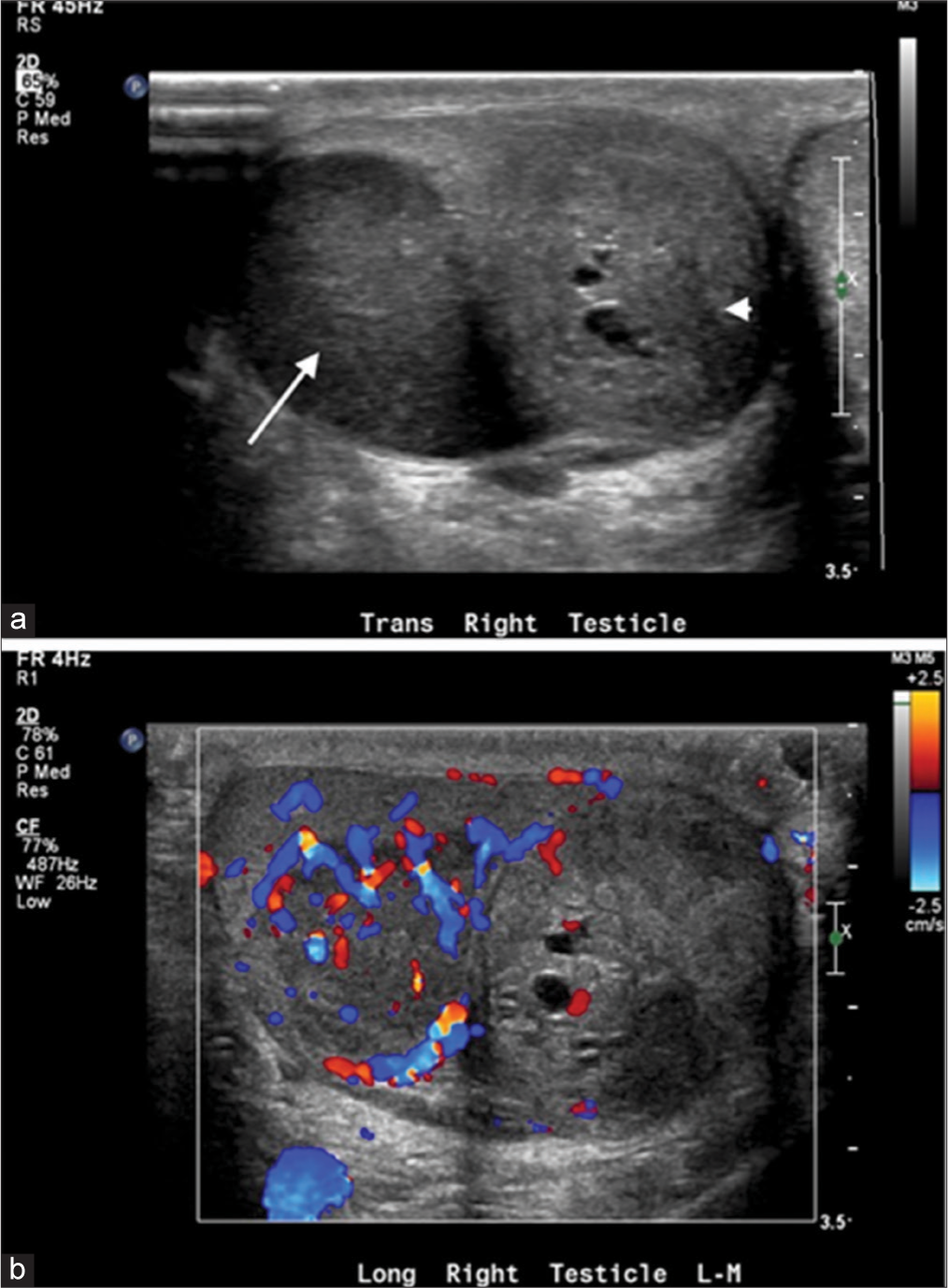 A 40-year-old male with synchronous testicular tumors. (a) Gray scale US of the right testis demonstrates two intratesticular masses. There is a solid hypoechoic mass that measures 3.3 cm (arrow) and a heterogeneous, slightly hypoechoic lesion with cystic changes (arrowhead) that measure 2.6 cm. (b) Color Doppler demonstrates increased vascularity in the solid mass. The mass with cystic changes is relatively hypovascular.