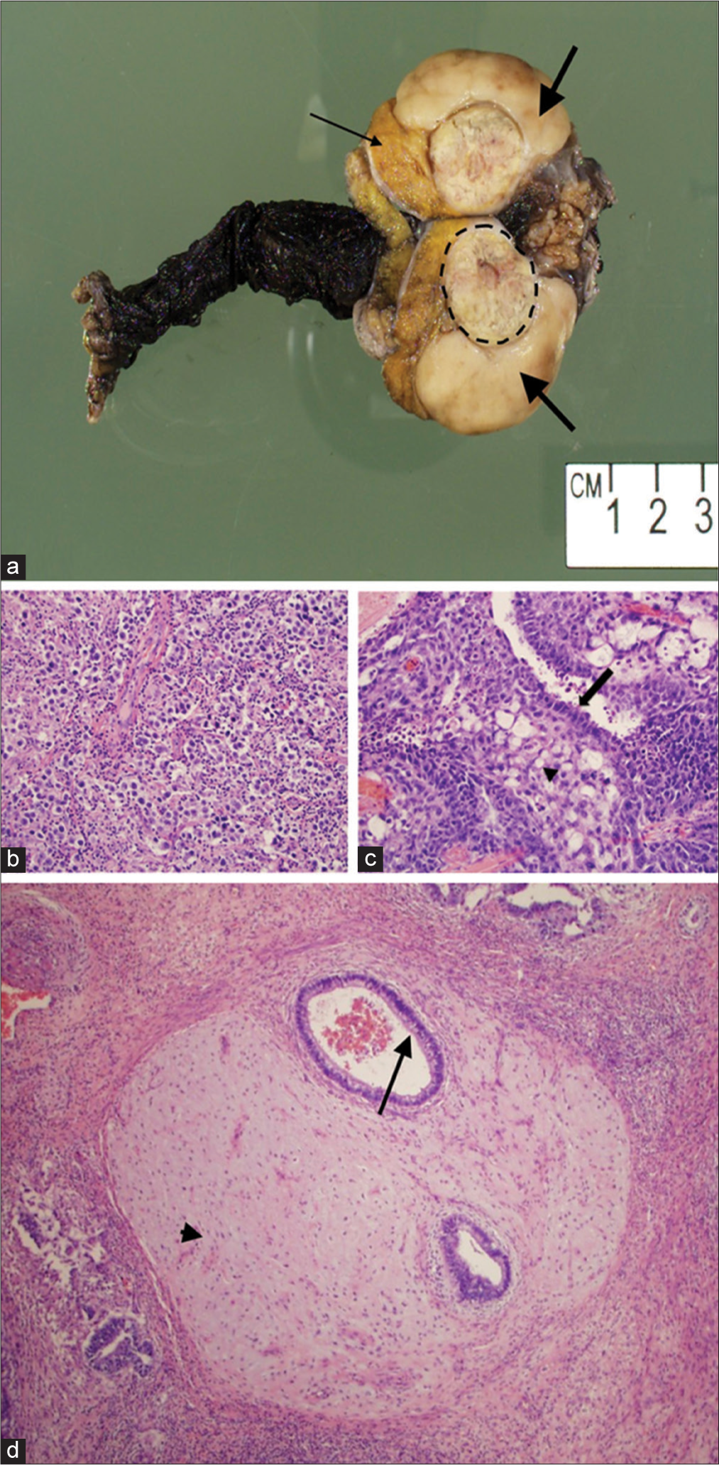 A 40-year-old male with synchronous testicular tumors. (a) Photograph of the excised testis demonstrates a 4.2 cm seminoma (thick arrows), 2.3 cm mixed germ cell tumor (dashed circle), and normal testicular parenchyma (thin arrow). (b) High-power (20x) hematoxylin and eosin stained (H and E) image of the seminoma. (c) High-power (20x) H and E image of the embryonal carcinoma (arrow) and yolk sac tumor (arrowhead) component of the mixed germ cell tumor. (d) High-power (4x) H and E image demonstrates the teratoma portion of the mixed germ cell tumor containing cartilage (arrowhead) and bronchial glandular epithelium (arrow).