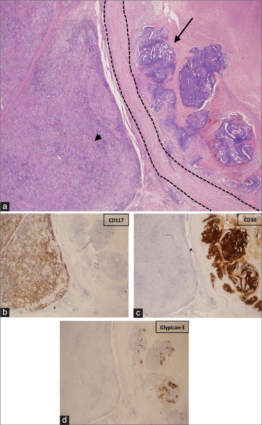 A 40-year-old male with synchronous testicular tumors. (a) Low-power (2x) hematoxylin and eosin (H and E) stained image demonstrates seminoma (arrowhead) and mixed germ cell tumor (arrow) with a fibrous capsule separating the two tumors (dashed lines). (b) CD117 immunohistochemical stain highlighting the seminoma tumor. (c) CD30 immunohistochemical stain highlighting the embryonal carcinoma. (d) Glypican-3 immunohistochemical stain highlighting the yolk sac tumor.