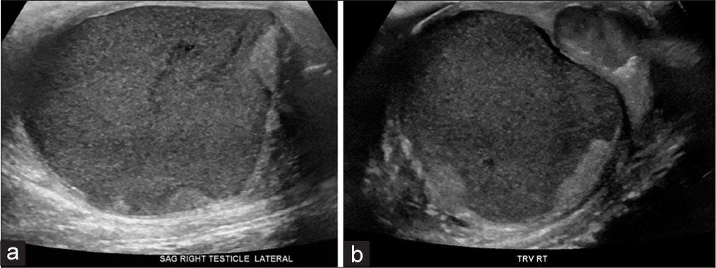 A 27-year-old man presented to the emergency department with several days of the right scrotal swelling, erythema, and mild pain. Sagittal (a) and transverse (b) sonographic images through the right testicle demonstrate gross replacement of the normal testicular parenchyma with a complex fluid collection, with peripheralization of the scant residual testicular parenchyma.