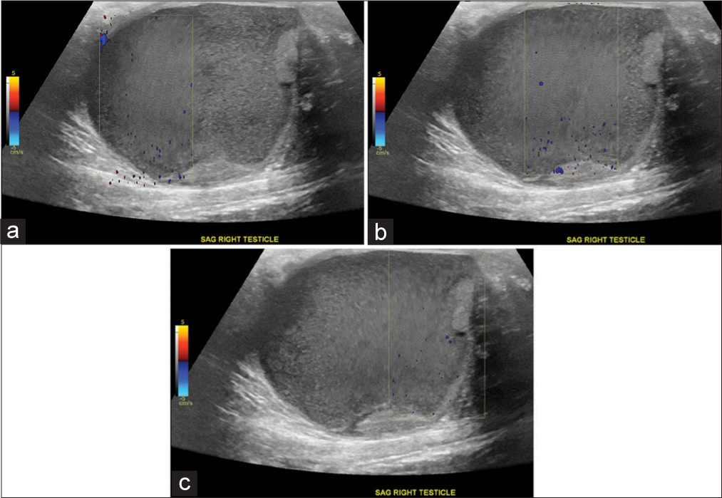 A 27-year-old man who presented to the emergency department with several days of the right scrotal swelling, scrotal erythema, and mild pain. Doppler ultrasound images of large complex fluid collection replacing the right testicle in the sagittal plane (a, b, c) demonstrate perception of fluid movement through acoustic streaming even on serial still captures, focused within Doppler tracer box.