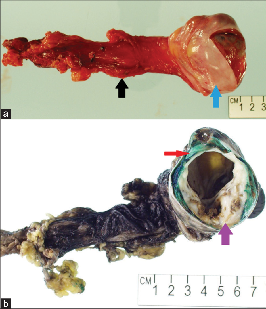 A 27-year-old man who presented to the emergency department with several days of the right scrotal swelling, scrotal erythema, and mild pain. Gross photographs taken of the surgical specimen (a) and after inking in the pathology laboratory (b) demonstrate resection specimen including the spermatic cord (black arrow) and testicle (blue arrow). There is gross heterogeneous replacement of the normal testicular parenchyma by a multicystic neoplasm with necrosis (purple arrow) and a small peripheral rind of normal testicular parenchyma (red arrow).