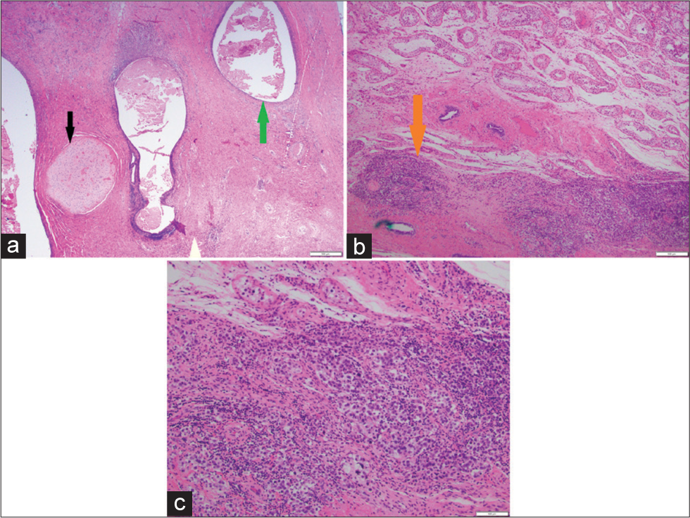 A 27-year-old man who presented to the emergency department with several days of the right scrotal swelling, scrotal erythema, and mild pain. Histopathologic sections through the testicle at low power (a) demonstrate nests of pink cartilaginous deposits (black arrow) interspersed with vacuoles hemorrhage (green arrow). Successively higher power microscopic images (b, c) demonstrate focal areas of higher cellularity, the individual cells of which are characterized by prominent nucleoli and clear cytoplasm, suggesting a seminomatous component (orange arrow). Final diagnosis of mixed germ cell tumor consisting of 90% teratoma and 10% seminoma.