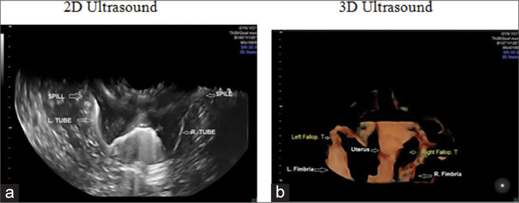 (a) A 25-year-old women with 6 years of infertility. Two-dimensional hysterosalpingo contrast sonography (HyCoSy) with lignosal contrast showed both tubes as echogenic and spill from fimbrial ends as a shower suggests, bilateral tubal patency. (b) The three-dimensional HyCoSy image of the same patient (25-year-old women with 6 years of infertility) shows both tubes and fimbrial ends.