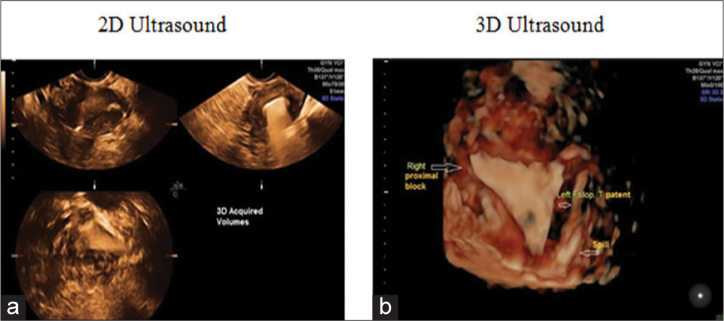 (a) A 32-year-old lady with 13 years of infertility. H/o right salpingectomy for previous ectopic pregnancy. Two-dimensional hysterosalpingo contrast sonography (HyCoSy) with lignosal shows nonvisualization of both tubes and spill suggests a bilateral proximal block. (b) Three-dimensional HyCoSy of the same patient shows nonvisualization of both tubes (bilateral proximal block).