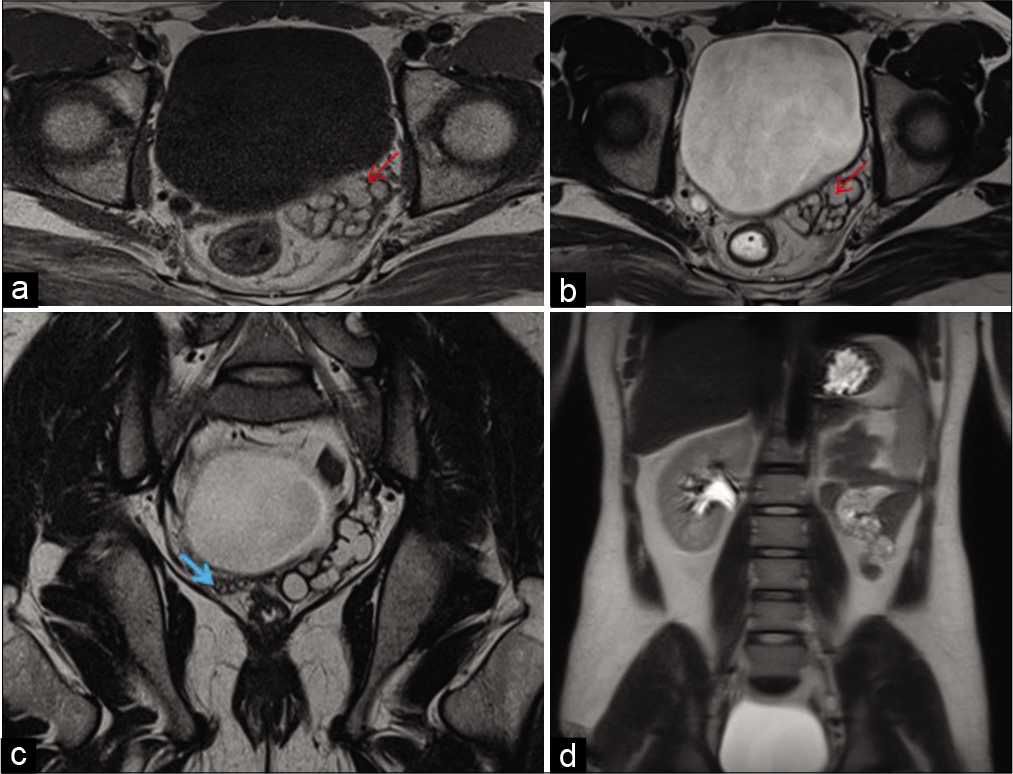 A 28-year-old adult male presented with pain during ejaculation and primary infertility. (a and b) Axial T1 and T2 TSE sequences show multiple cystic hyperintense structures lying close together, in the region of the left seminal vesicle (red arrow). (c) Coronal T2WI images normal right seminal vesicle (blue arrow) – left seminal vesicle cyst. (d) Coronal T2-weighted HASTE MRI showing normal right kidney and absence of the left kidney – left renal agenesis.