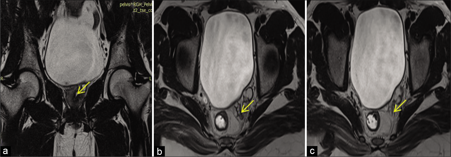 A 28-year-old adult male presented with pain during ejaculation and primary infertility. (a) Coronal T2WI showing obstruction of ejaculatory duct (yellow arrow). (b and c) Consecutive axial T2-weighted TSE MRI showing dilated tortuous vas deferens (yellow arrow) – left ejaculatory duct obstruction.